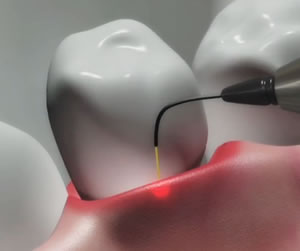 Link to more info about Laser Dentistry