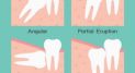 wisdomteethdentist