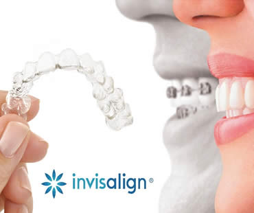 Private: Invisalign versus Metal Braces