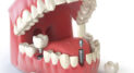 Private: Benefits of Dental Implants