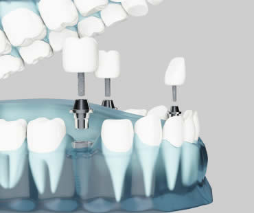 Dental Implants: Choosing the Best Implant Dentist in Reynoldsburg